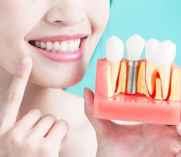 Cấy ghép Implant nha khoa